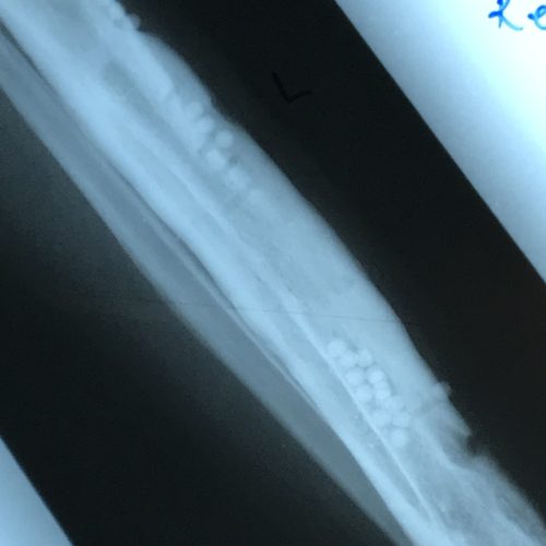 Bone filling with antibiotic beads