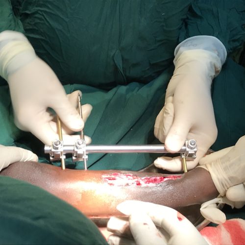 Placing an external fixator